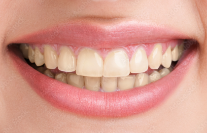 Teeth Whitening - Before