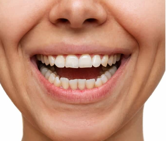 Teeth Whitening - Before